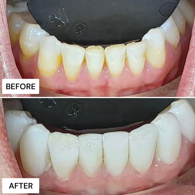 Before and after result