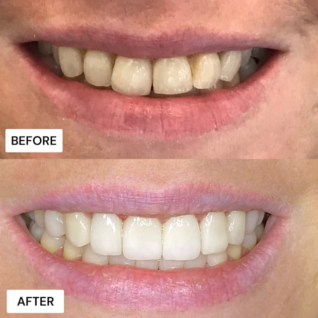 Before and after result
