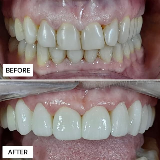 Before and after result