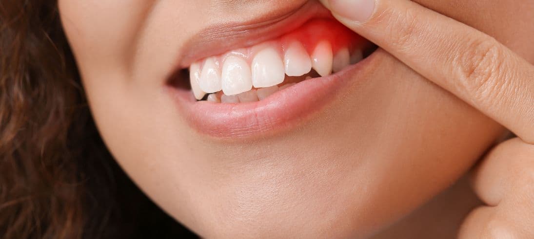Early Signs of Gum Disease You Should Never Ignore