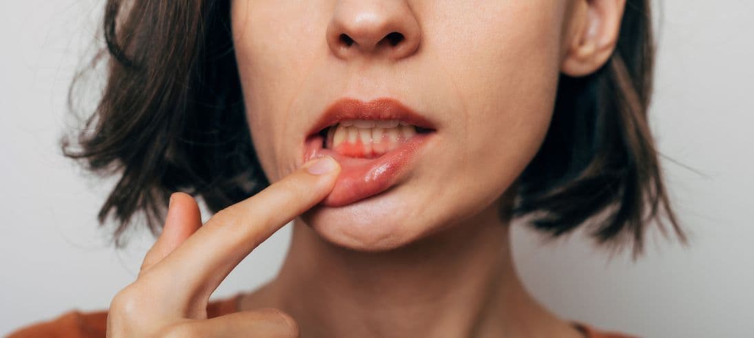 Bleeding Gums: Causes, Treatment & Prevention