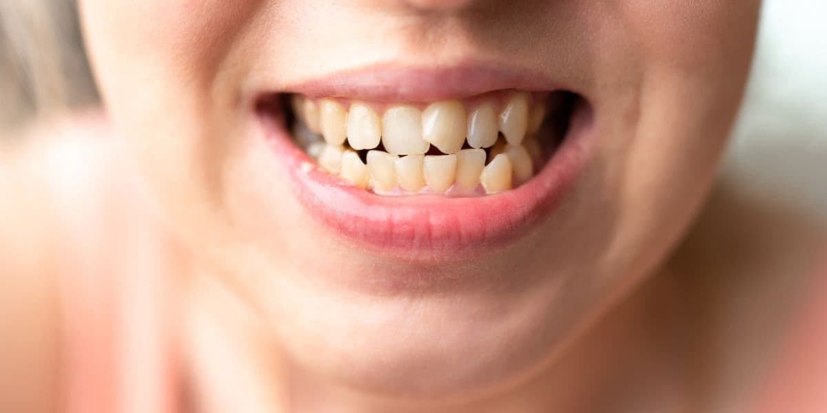 Night Guards: Protecting Teeth from Grinding