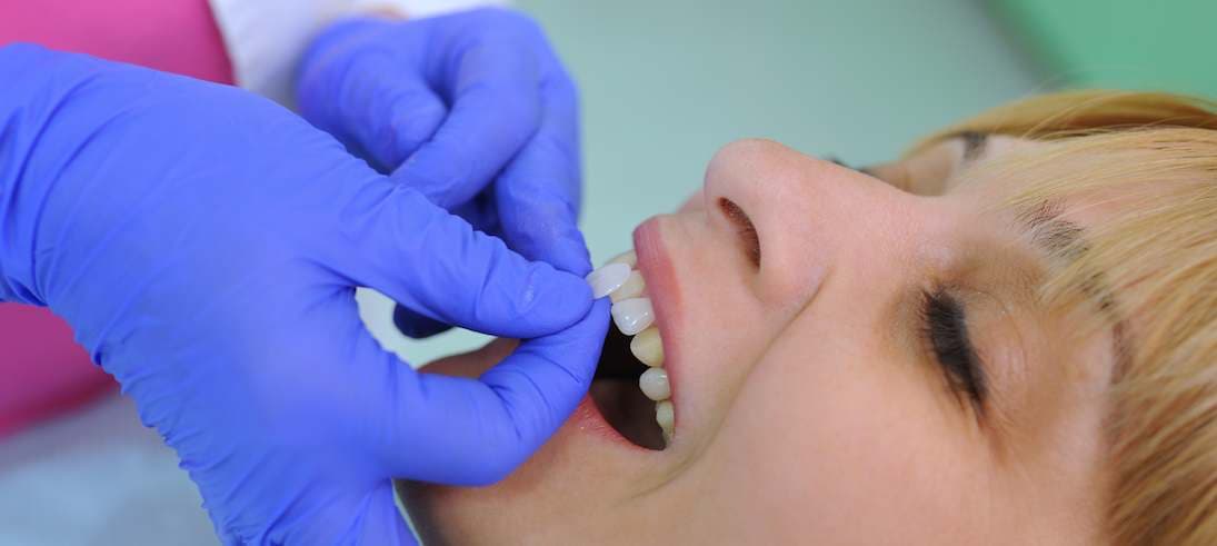 How to Clean Around Supernumerary Teeth Before Removal