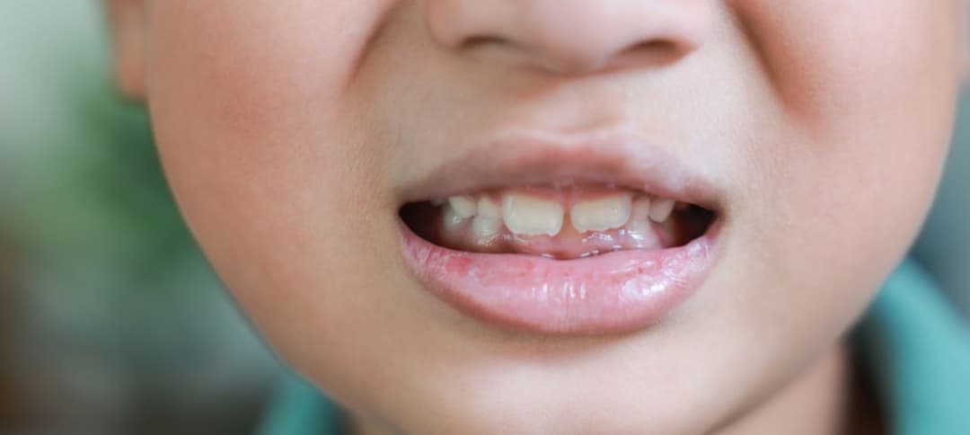 Why Gum Health Can Affect Comfort When Eating Hard Foods