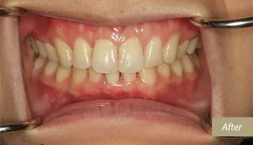 Invisalign after 5